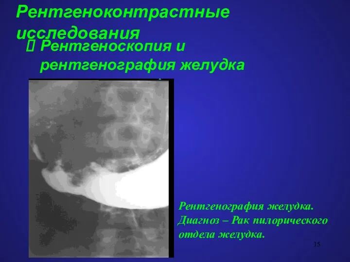 Рентгеноконтрастные исследования Рентгеноскопия и рентгенография желудка Рентгенография желудка. Диагноз – Рак пилорического отдела желудка.