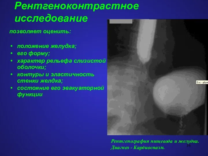 Рентгеноконтрастное исследование позволяет оценить: положение желудка; его форму; характер рельефа