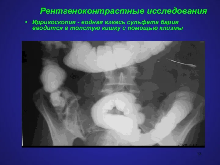 Рентгеноконтрастные исследования Ирригоскопия - водная взвесь сульфата бария вводится в толстую кишку с помощью клизмы