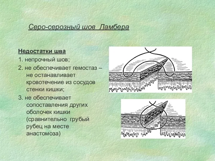 Серо-серозный шов Ламбера Недостатки шва 1. непрочный шов; 2. не