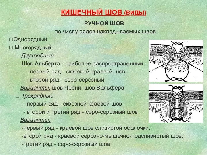 КИШЕЧНЫЙ ШОВ (ВИДЫ) РУЧНОЙ ШОВ по числу рядов накладываемых швов Однорядный  Многорядный