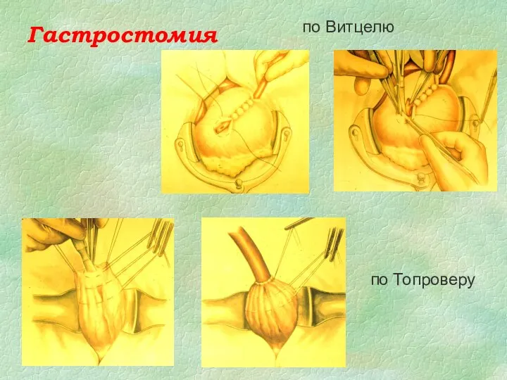 Гастростомия по Витцелю по Топроверу