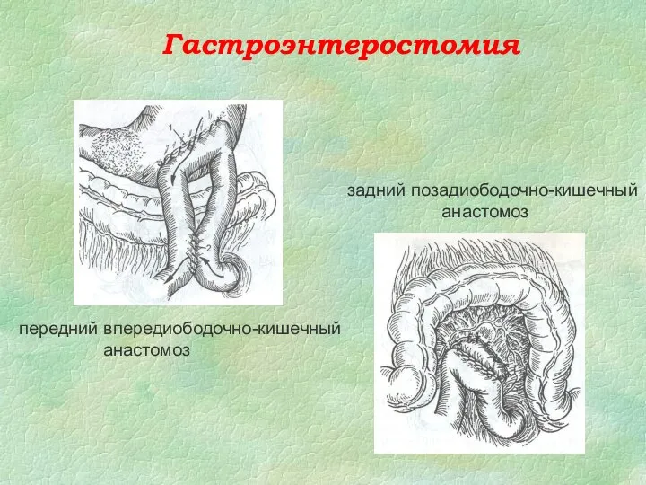 Гастроэнтеростомия передний впередиободочно-кишечный анастомоз задний позадиободочно-кишечный анастомоз