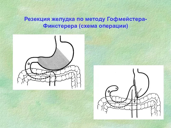 Резекция желудка по методу Гофмейстера-Финстерера (схема операции)