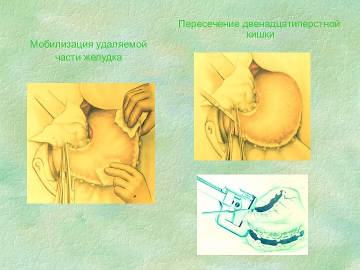 Мобилизация удаляемой части желудка Пересечение двенадцатиперстной кишки
