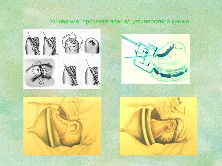 Ушивание просвета двенадцатиперстной кишки