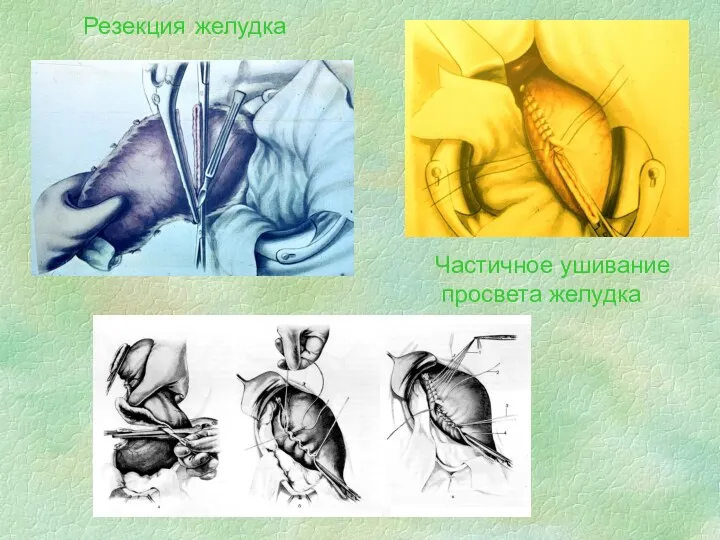 Резекция желудка Частичное ушивание просвета желудка