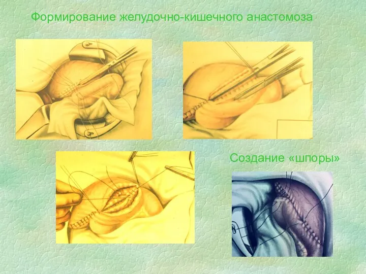 Формирование желудочно-кишечного анастомоза Создание «шпоры»