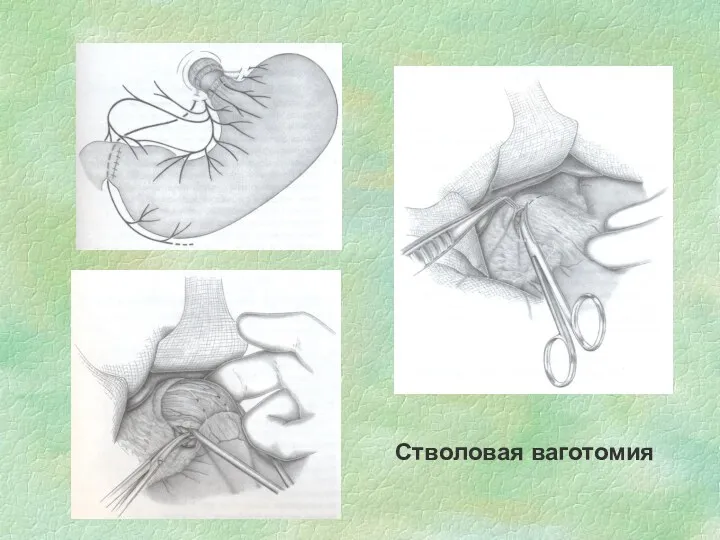 Стволовая ваготомия