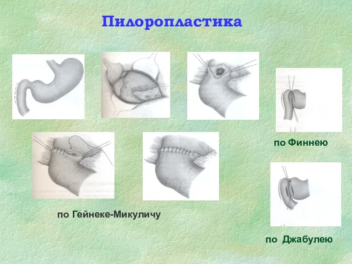 по Гейнеке-Микуличу по Финнею по Джабулею Пилоропластика