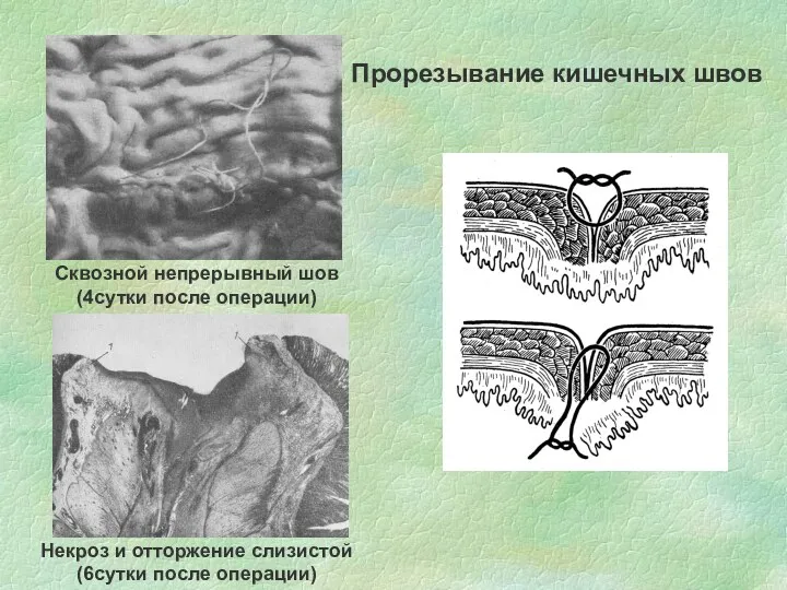 Прорезывание кишечных швов Сквозной непрерывный шов (4сутки после операции) Некроз и отторжение слизистой (6сутки после операции)