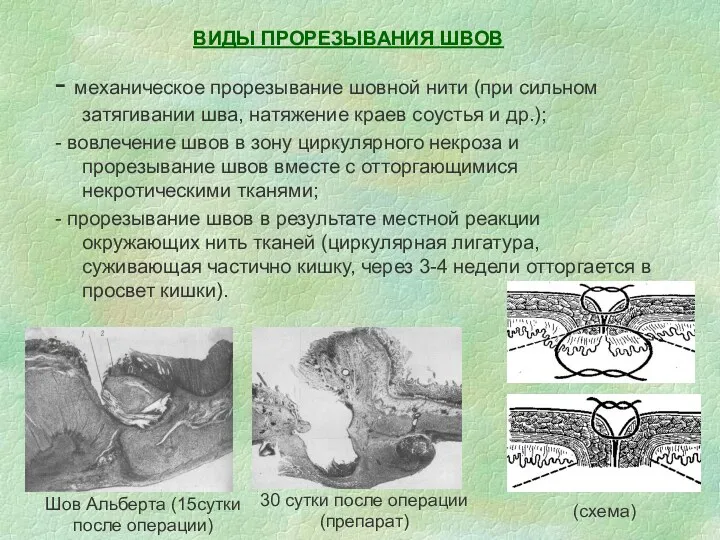 ВИДЫ ПРОРЕЗЫВАНИЯ ШВОВ - механическое прорезывание шовной нити (при сильном