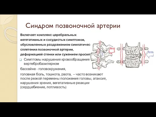 Синдром позвоночной артерии Включает комплекс церебральных вегетативных и сосудистых симптомов, обусловленных раздражением симпатического