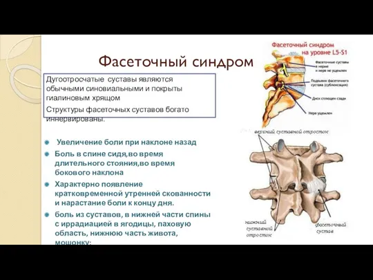 Фасеточный синдром Дугоотросчатые суставы являются обычными синовиальными и покрыты гиалиновым хрящом Структуры фасеточных