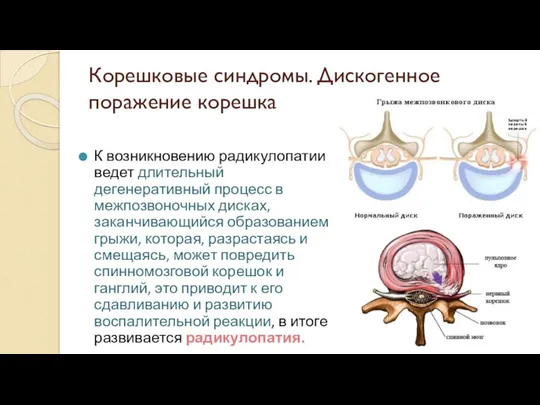 Корешковые синдромы. Дискогенное поражение корешка К возникновению радикулопатии ведет длительный