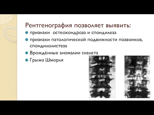 Рентгенография позволяет выявить: признаки остеохондроза и спондилеза признаки патологической подвижности позвонков, спондилолистеза Врождённые