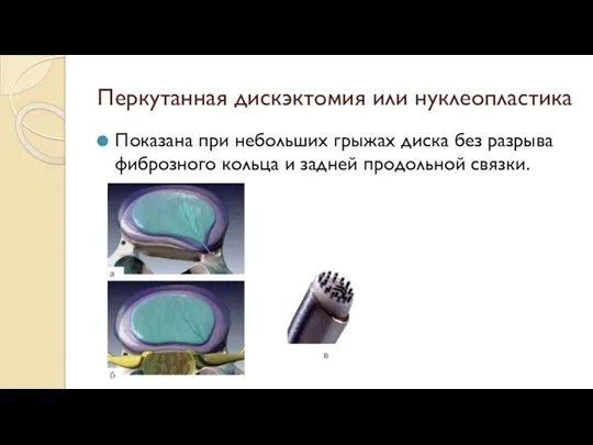 Перкутанная дискэктомия или нуклеопластика Показана при небольших грыжах диска без разрыва фиброзного кольца