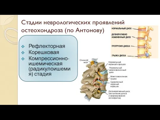 Стадии неврологических проявлений остеохондроза (по Антонову) Рефлекторная Корешковая Компрессионно-ишемическая (радикулоишемия) стадия