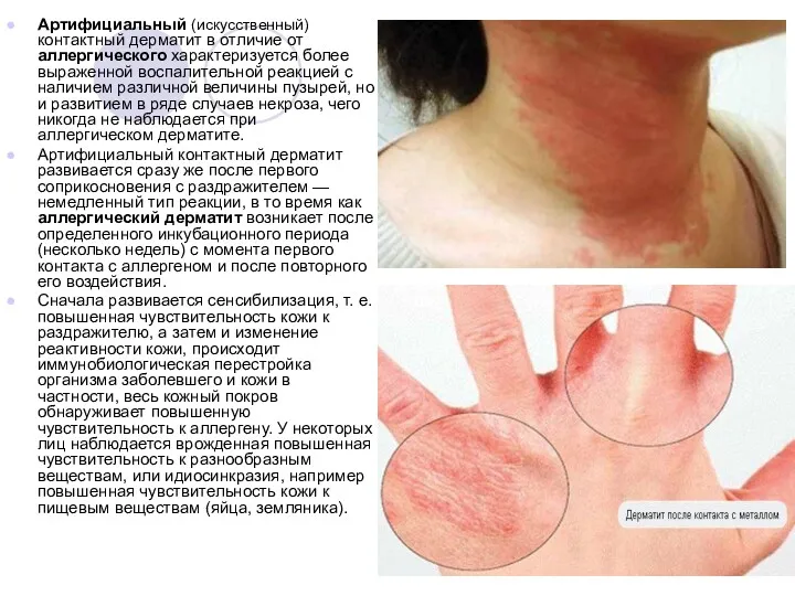 Артифициальный (искусственный) контактный дерматит в отличие от аллергического характеризуется более