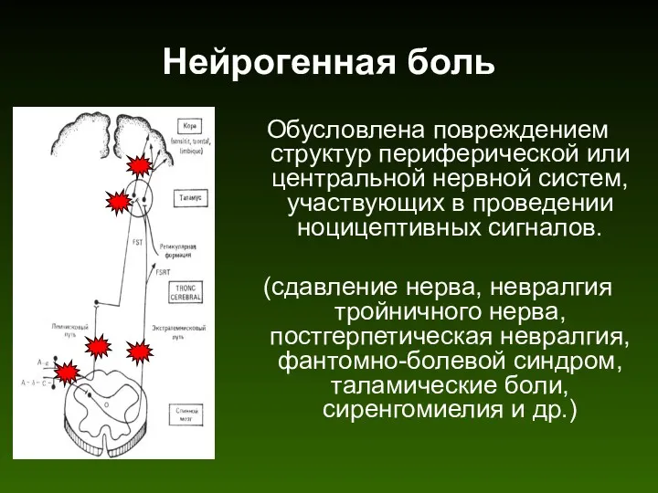 Нейрогенная боль Обусловлена повреждением структур периферической или центральной нервной систем,