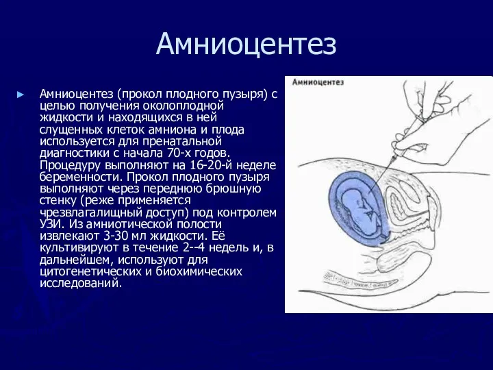 Амниоцентез Амниоцентез (прокол плодного пузыря) с целью получения околоплодной жидкости