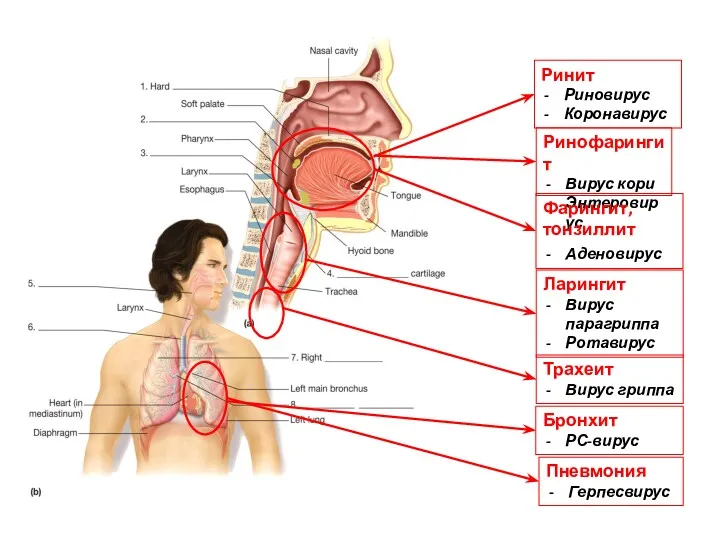 Ринит Риновирус Коронавирус Ринофарингит Вирус кори Энтеровирус Фарингит, тонзиллит Аденовирус