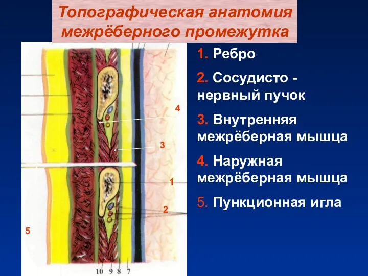 Топографическая анатомия межрёберного промежутка 1. Ребро 2. Сосудисто - нервный пучок 3. Внутренняя