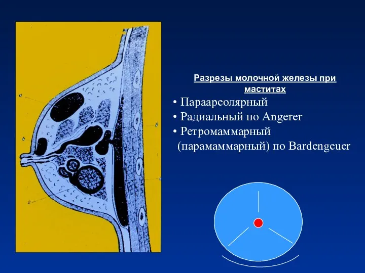 Разрезы молочной железы при маститах Параареолярный Радиальный по Angerer Ретромаммарный (парамаммарный) по Bardengeuer
