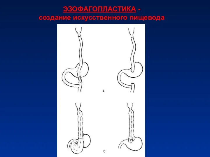 ЭЗОФАГОПЛАСТИКА - создание искусственного пищевода