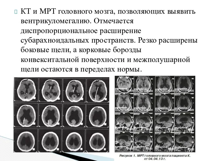 КТ и МРТ головного мозга, позволяющих выявить вентрикуломегалию. Отмечается диспропорциональное расширение субарахноидальных пространств.