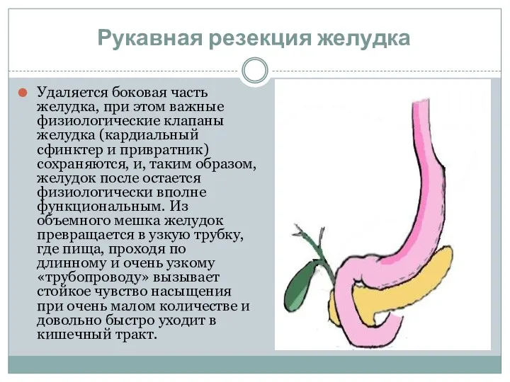 Рукавная резекция желудка Удаляется боковая часть желудка, при этом важные