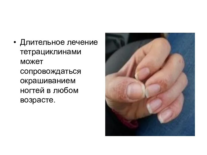 Длительное лечение тетрациклинами может сопровождаться окрашиванием ногтей в любом возрасте.