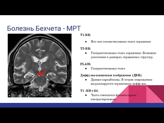 Болезнь Бехчета - МРТ T1-ВИ: Изо-или гипоинтенсивные очаги поражения Т2-ВИ: