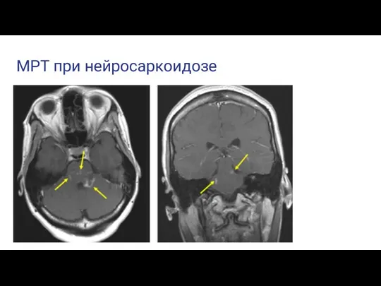 МРТ при нейросаркоидозе