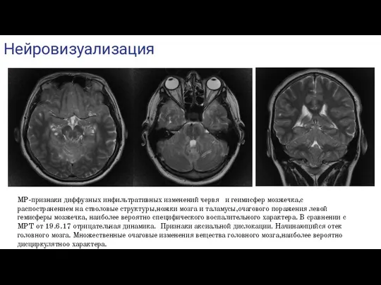 Нейровизуализация МР-признаки диффузных инфильтративных изменений червя и геимисфер мозжечка,с распостранением