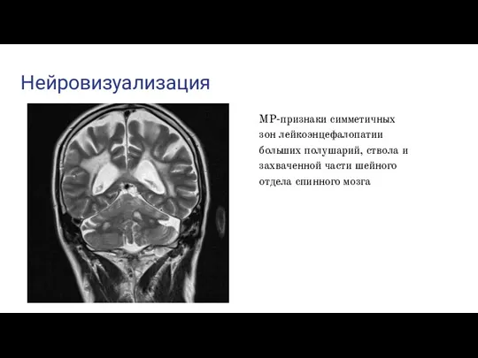 Нейровизуализация МР-признаки симметичных зон лейкоэнцефалопатии больших полушарий, ствола и захваченной части шейного отдела спинного мозга
