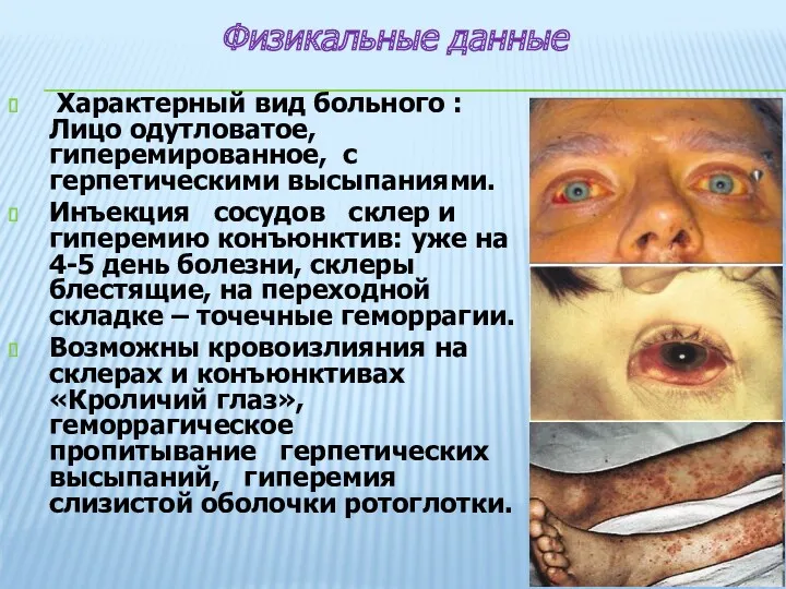 Характерный вид больного : Лицо одутловатое, гиперемированное, с герпетическими высыпаниями.