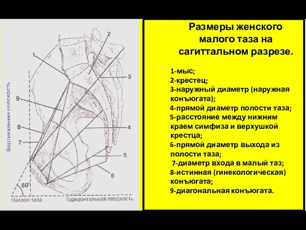 Размеры женского малого таза на сагиттальном разрезе. 1-мыс; 2-крестец; 3-наружный диаметр (наружная конъюгата);