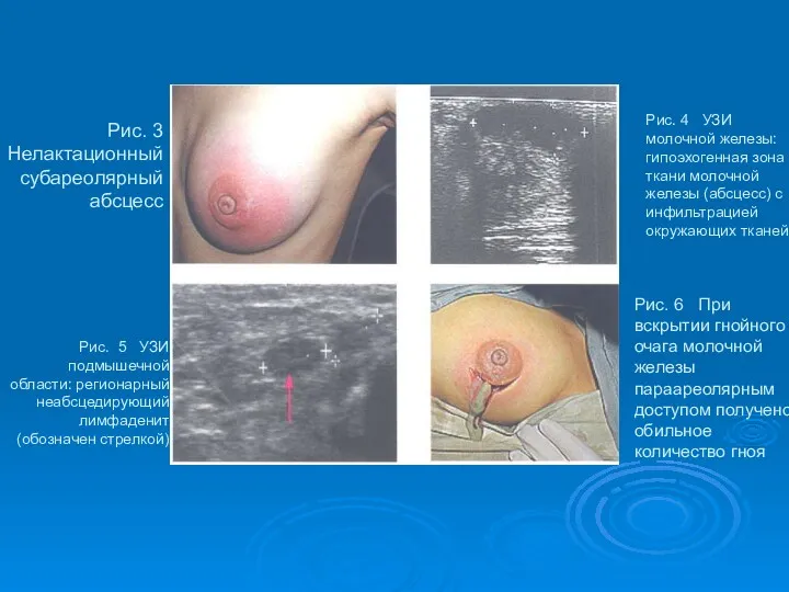 Рис. 3 Нелактационный субареолярный абсцесс Рис. 5 УЗИ подмышечной области: