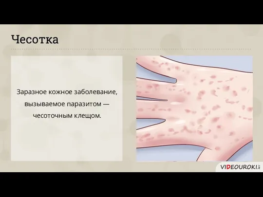 Чесотка Заразное кожное заболевание, вызываемое паразитом — чесоточным клещом.
