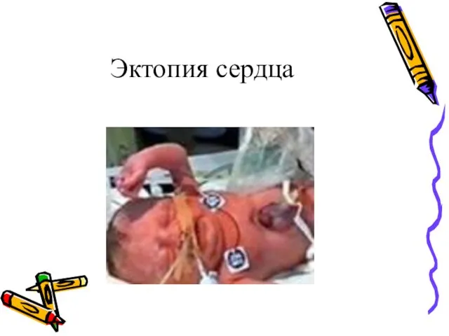 Эктопия сердца