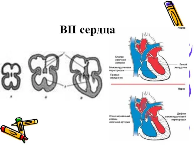 ВП сердца