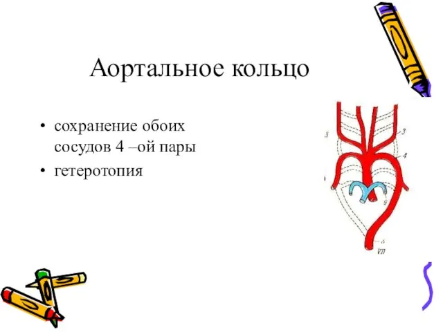 Аортальное кольцо сохранение обоих сосудов 4 –ой пары гетеротопия