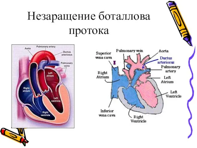 Незаращение боталлова протока