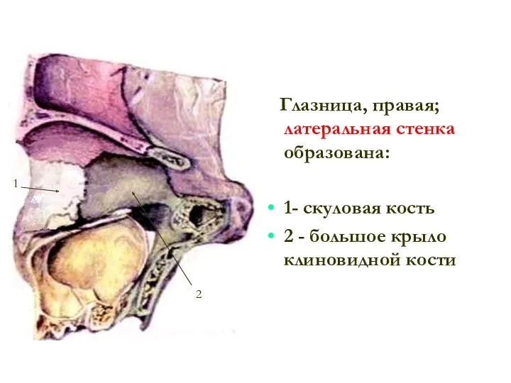 Глазница, правая; латеральная стенка образована: 1- скуловая кость 2 - большое крыло клиновидной кости 1 2