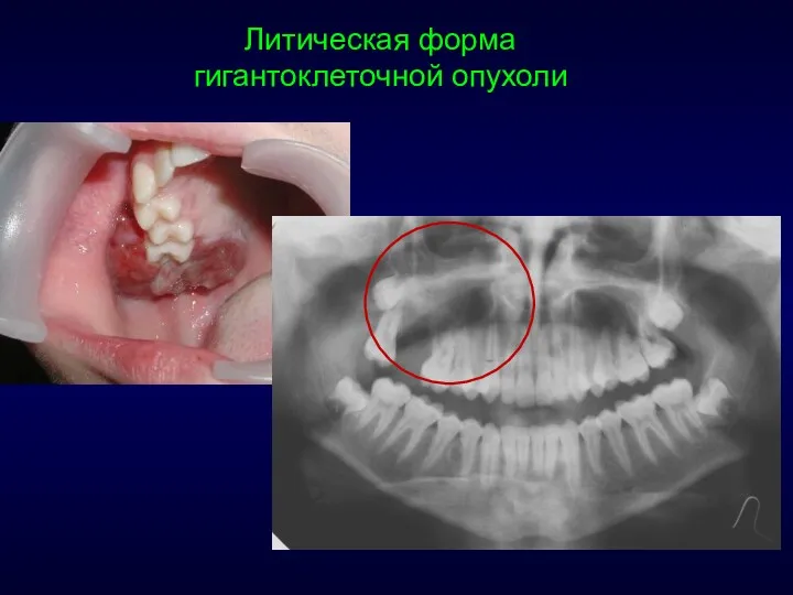 Литическая форма гигантоклеточной опухоли