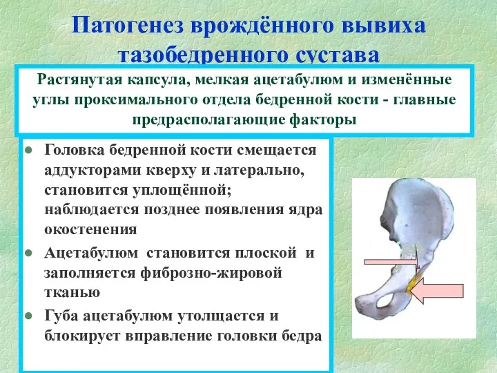 Патогенез врождённого вывиха тазобедренного сустава Головка бедренной кости смещается аддукторами