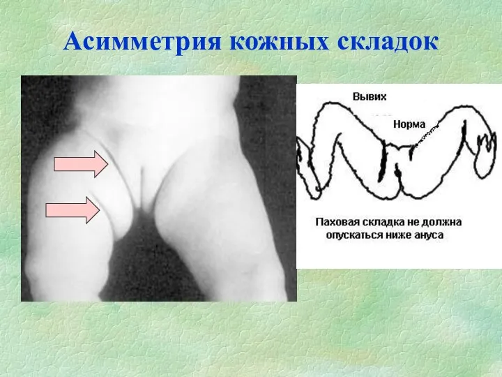 Асимметрия кожных складок