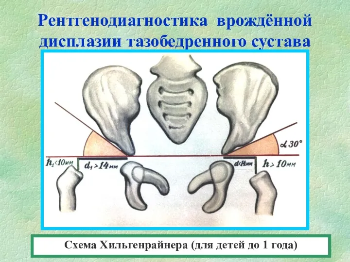 Рентгенодиагностика врождённой дисплазии тазобедренного сустава Схема Хильгенрайнера (для детей до 1 года)