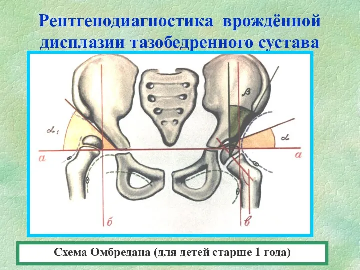 Рентгенодиагностика врождённой дисплазии тазобедренного сустава Схема Омбредана (для детей старше 1 года)